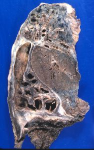 برونشکتازی