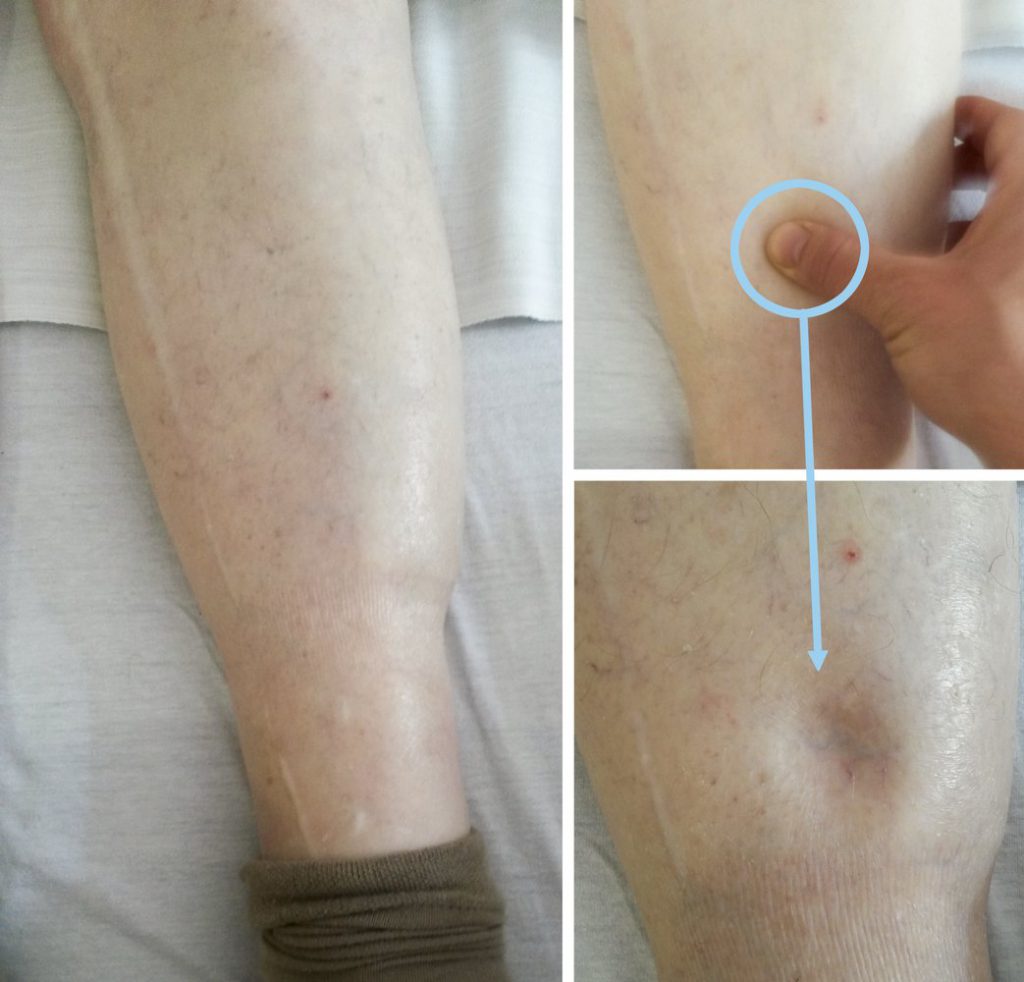 ادم اندام تحتانی