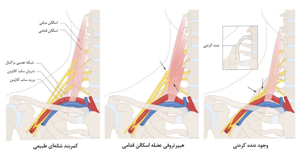 سندرم خروجی قفسه سینه (TOS)