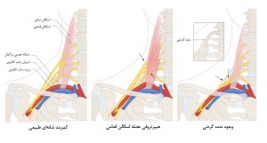 سندرم خروجی قفسه سینه (TOS)