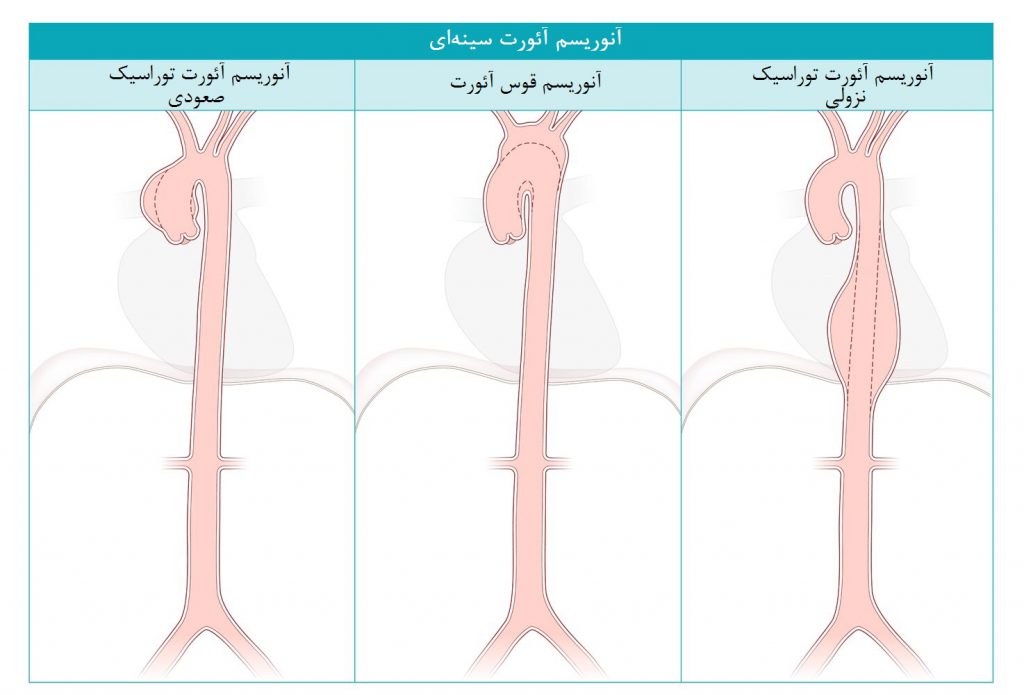 انواع آنوریسم آئورت توراسیک