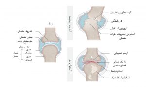 مقایسه درگیری مفصلی در RA و OA (استئوآرتریت)