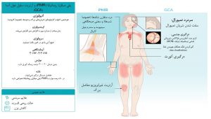 نگاه کلی به پلیمی‌الژیا روماتیکا و آرتریت سلول غول‌آسا