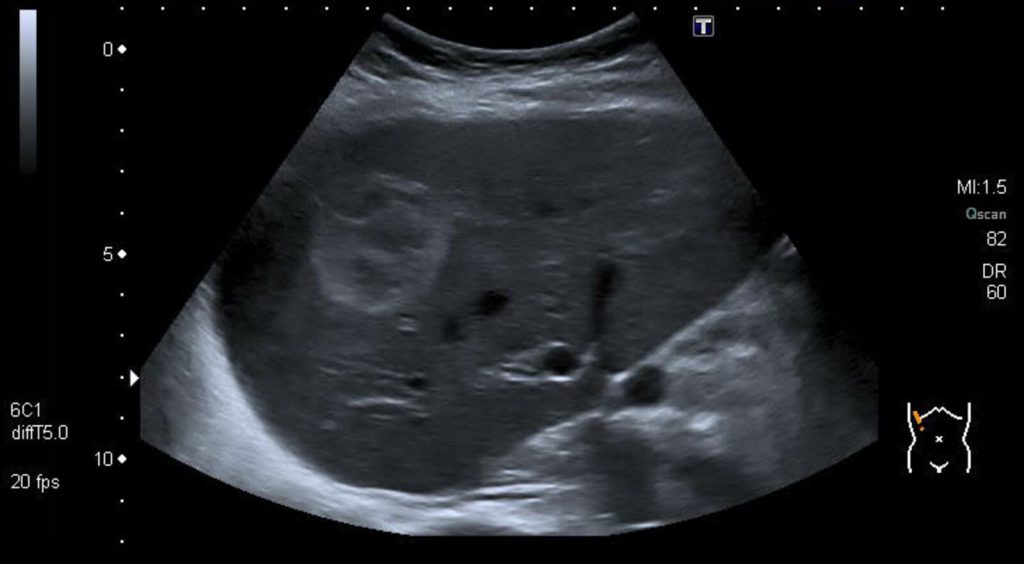 همانژیوم کبدی