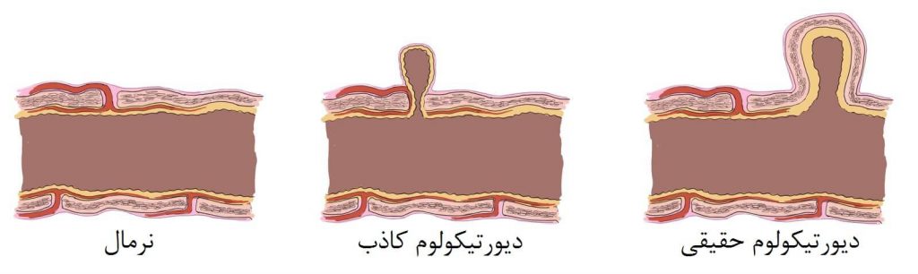 دیورتیکول حقیقی و دیورتیکول کاذب
