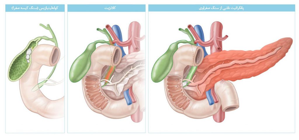 نگاه کلی به درگیریهای صفراوی