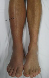DVT (ترومبوز ورید عمقی)