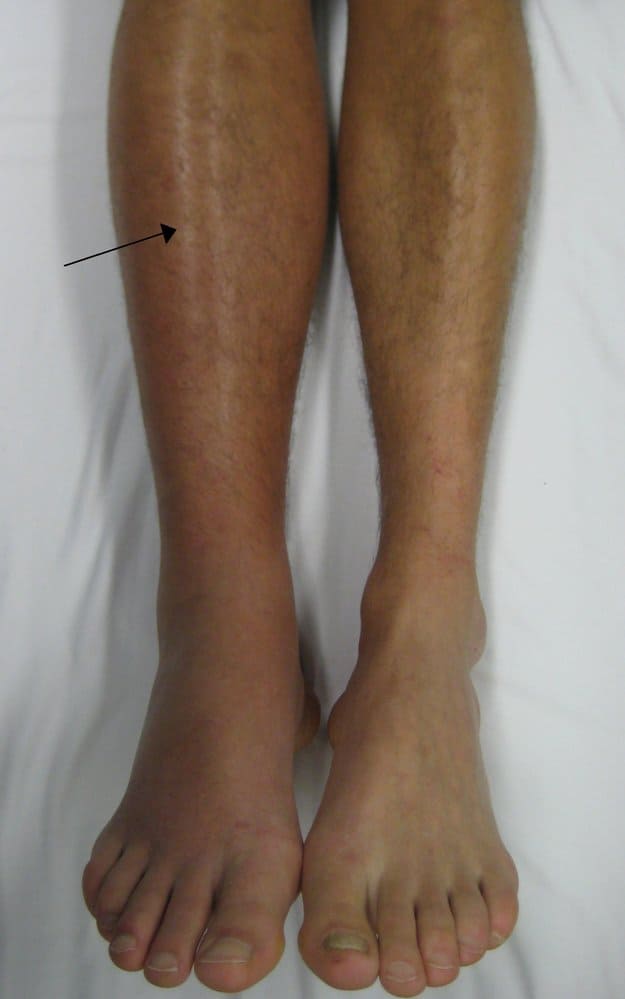 DVT (ترومبوز ورید عمقی)