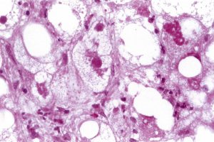 ارتشاح چربی در کبد