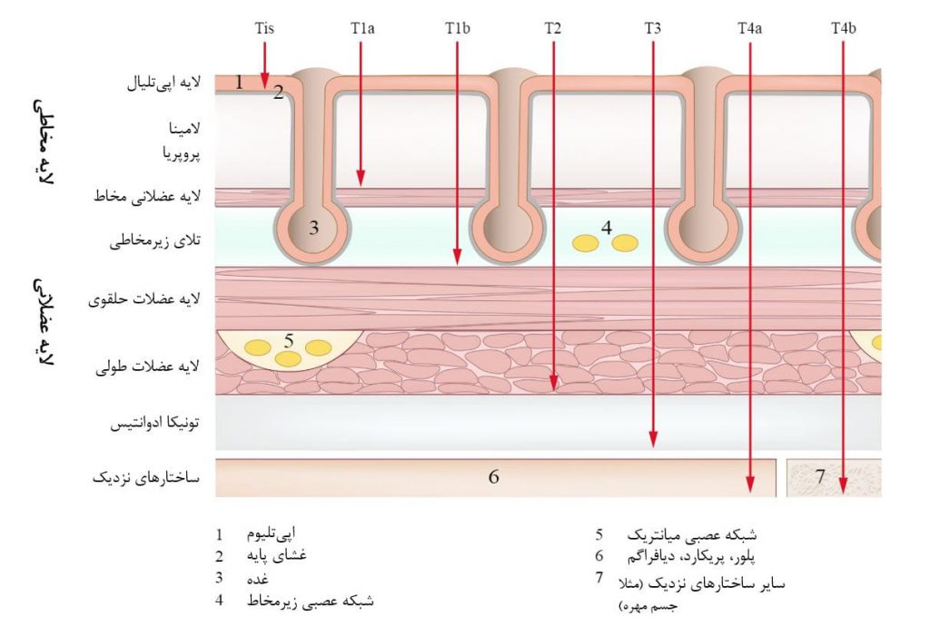 طبقه‌بندی سرطان معده