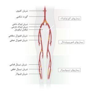 محل‌های انسداد شریانی در PAD