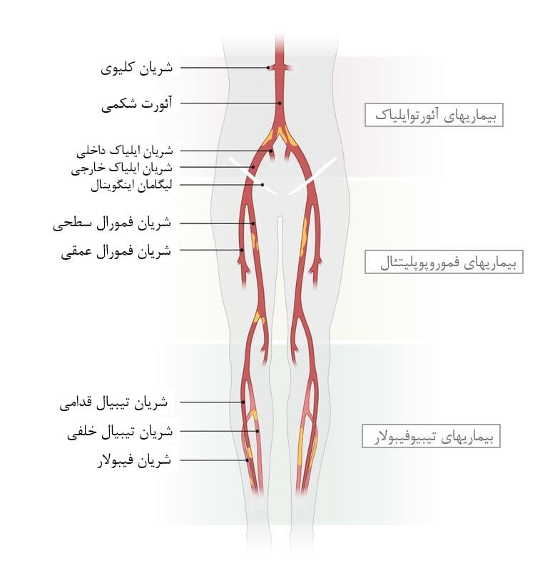 محل‌های انسداد شریانی در PAD