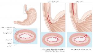 مقایسه بورهاو و مالوری-ویس