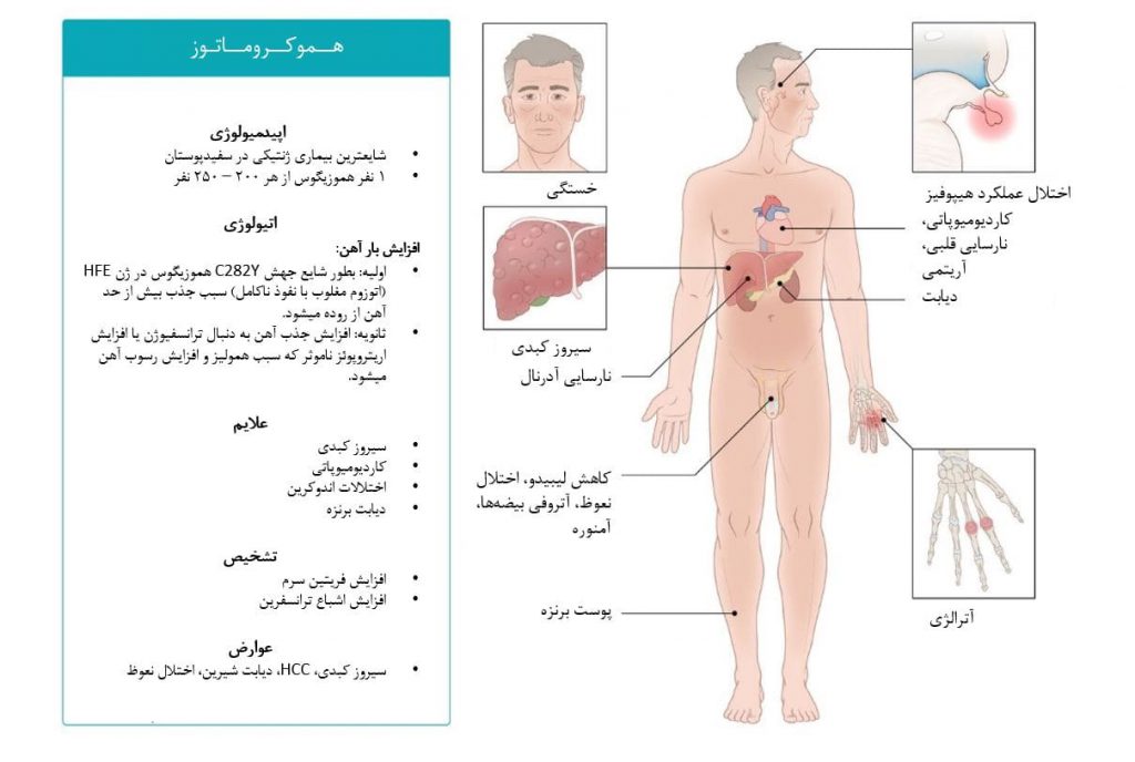 نگاه کلی به هموکروماتوز