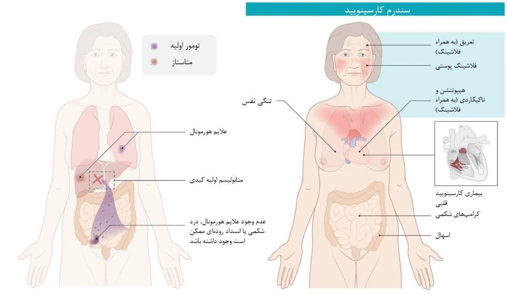 نگاه کلی به سندرم کارسینوئید