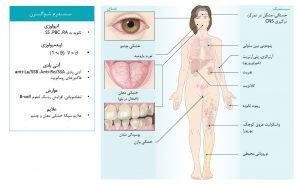نگاه کلینگاه کلی به سندرم شوگرن