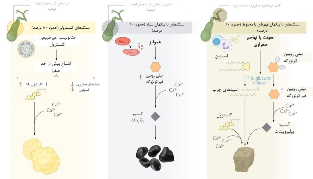 پاتوفیزیولوژی تشکیل انواع مختلف سنگ