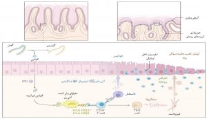 پاتوفیزیولوژی سلیاک