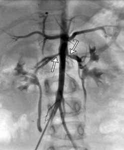 استنوز (تنگی) دوطرفه‌ی شریان کلیوی