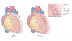 پریکاردیت حاد