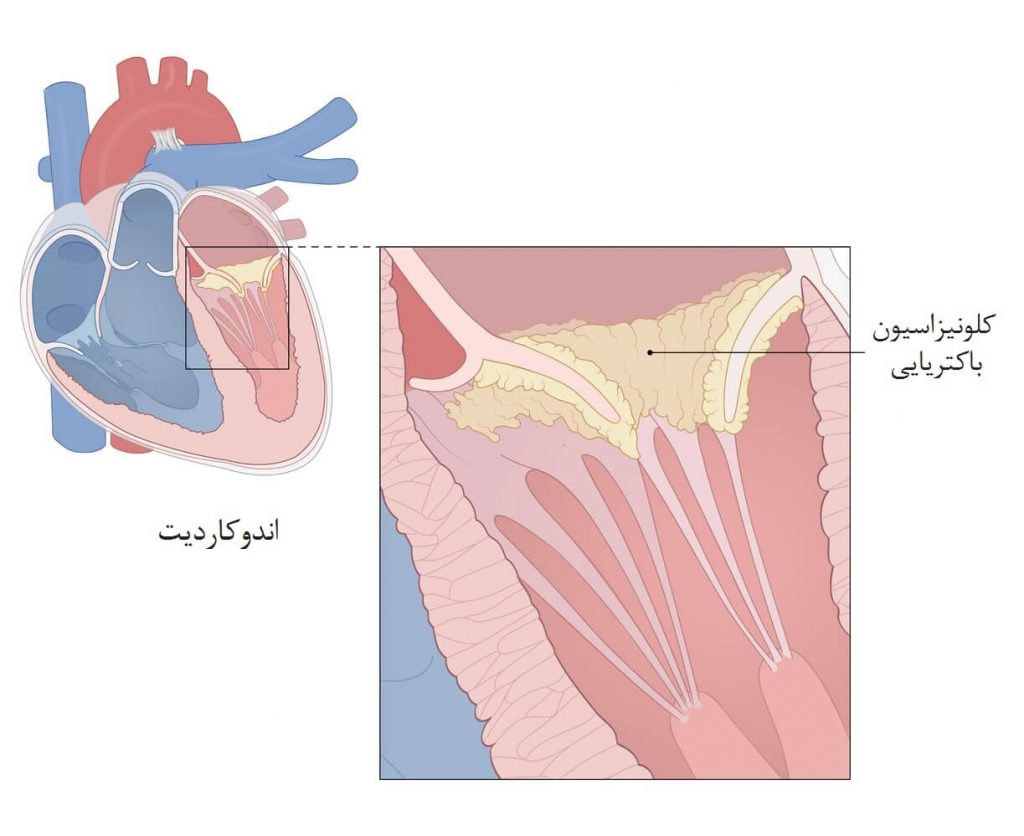 اندوکاردیت عفونی