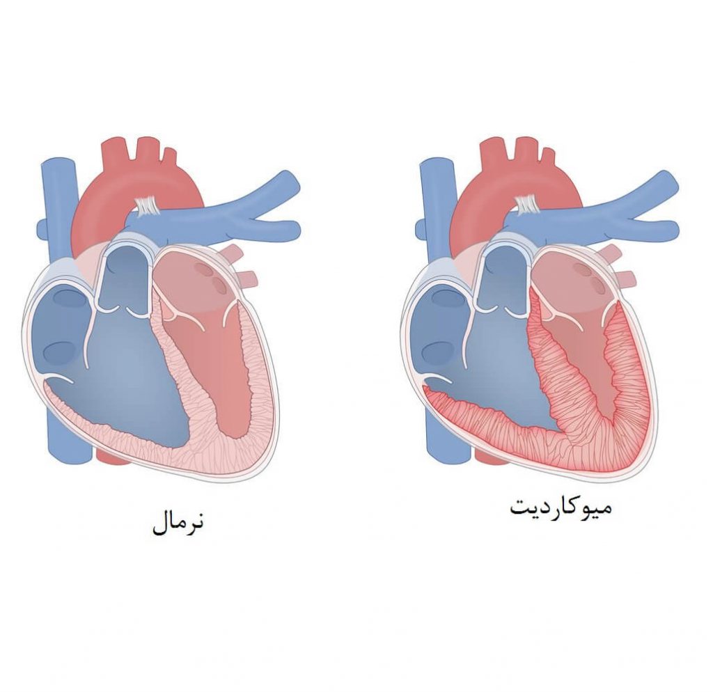 میوکاردیت
