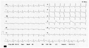 ضربانات زودرس فوق بطنی (Supraventricular premature beats)