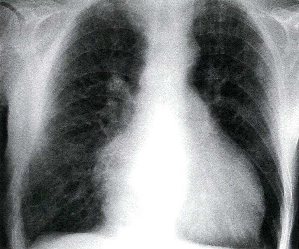 هایپرتروفی بطن چپ در استنوز (تنگی) دریچهی آئورت