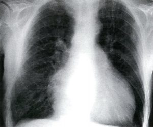 هایپرتروفی بطن چپ در استنوز (تنگی) دریچه‌ی آئورت