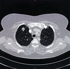 CT اسکن در گرانولوماتوز همراه با پلیآنژئیت