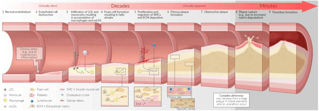 پاتوژنز آترواسکلروز