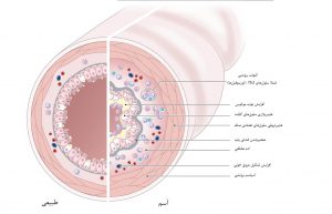 پاتوفیزیولوژی آسم