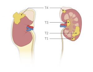 کارسینوم سلول کلیه: مراحل تومور