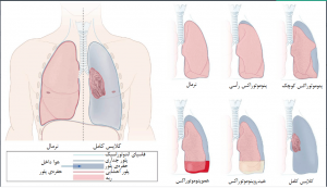انواع پنوموتوراکس