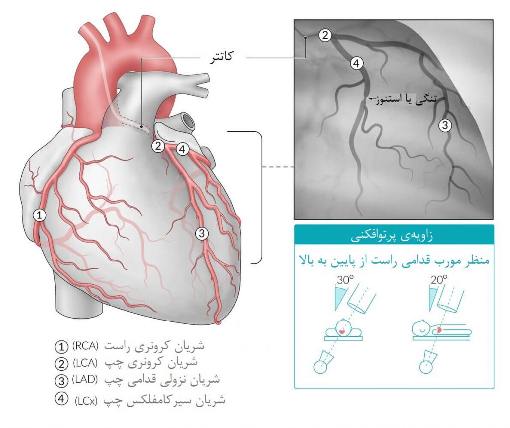 آنژیوگرافی کرونری شریان کرونری چپ (LCA)
