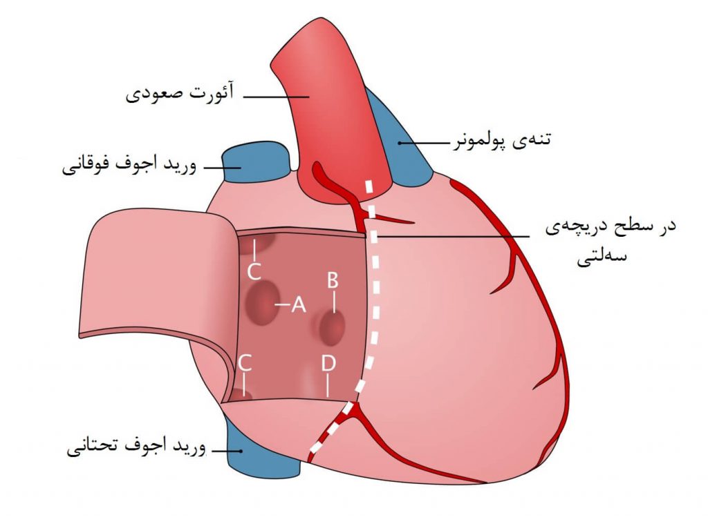 انواع نقص دیواره بین دهلیزی