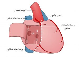 انواع نقص دیواره‌ بین دهلیزی