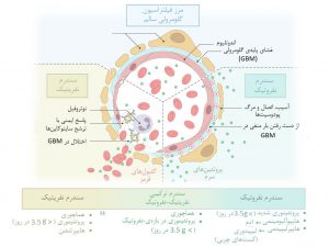 سندرم‌های نفروتیک و نفریتیک