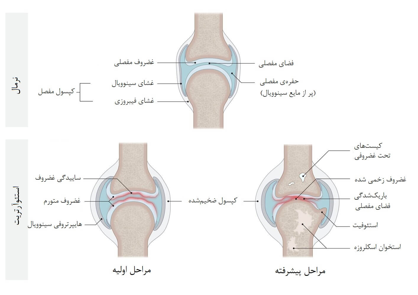 Pathophysiology oپاتوفیزیولوژی استئوآرتریتf osteoarthritis