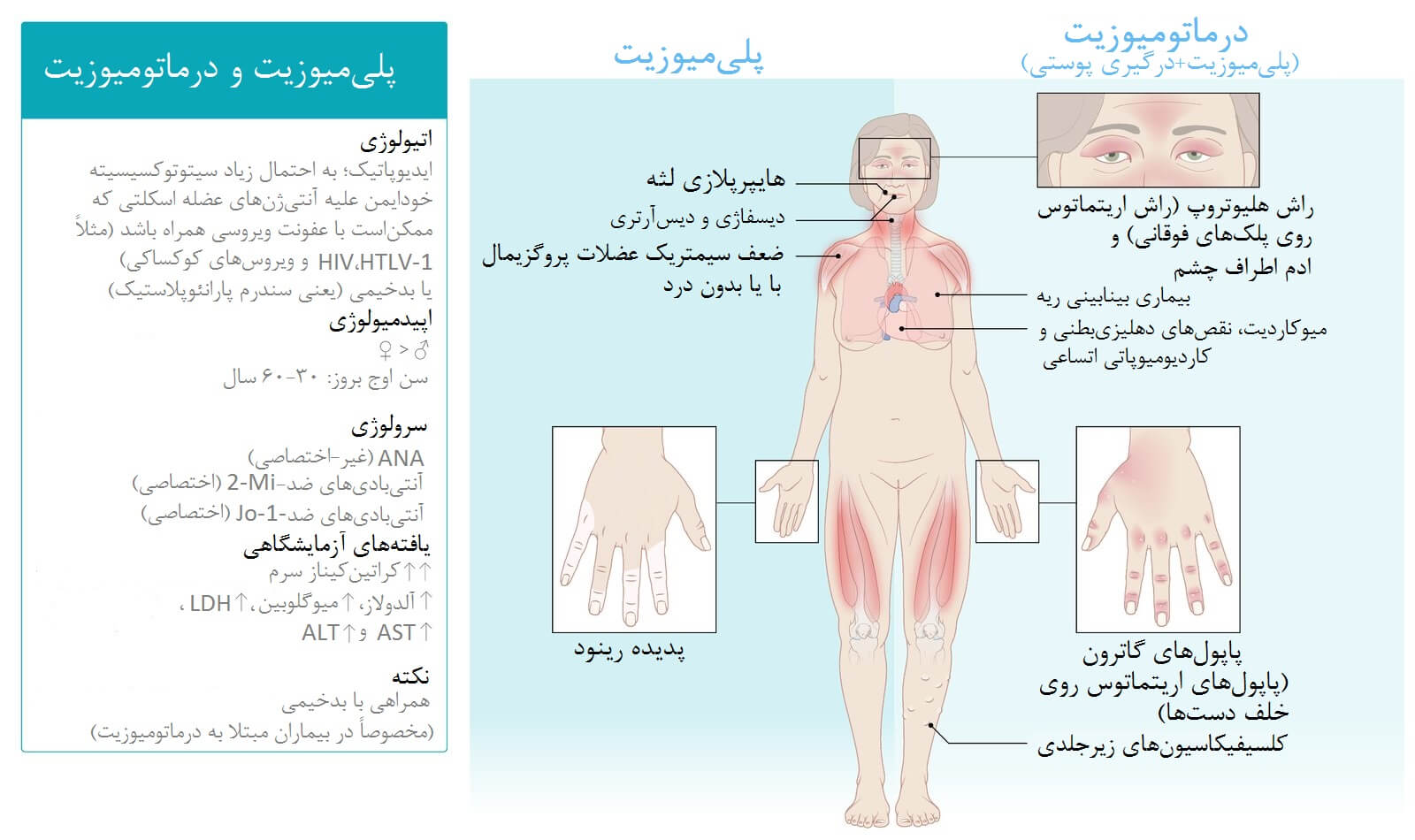 نکات کلی پلی‌میوزیت و درماتومیوزیت